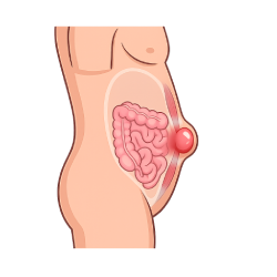 Illustration of an abdominal wall hernia