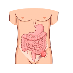 Illustration of an inguinal hernia